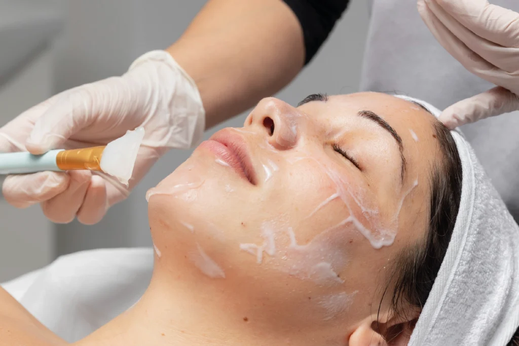 peeling quimico en marbella