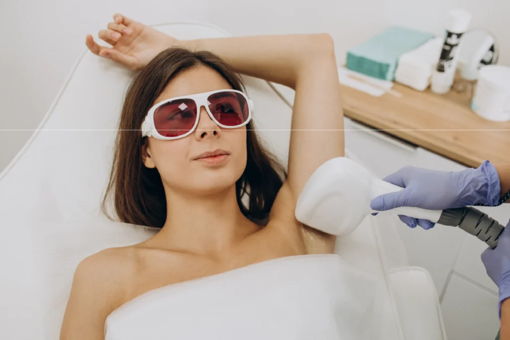 fotodepilacion en marbella